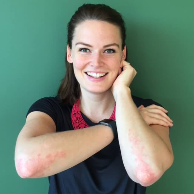 Psoriasis